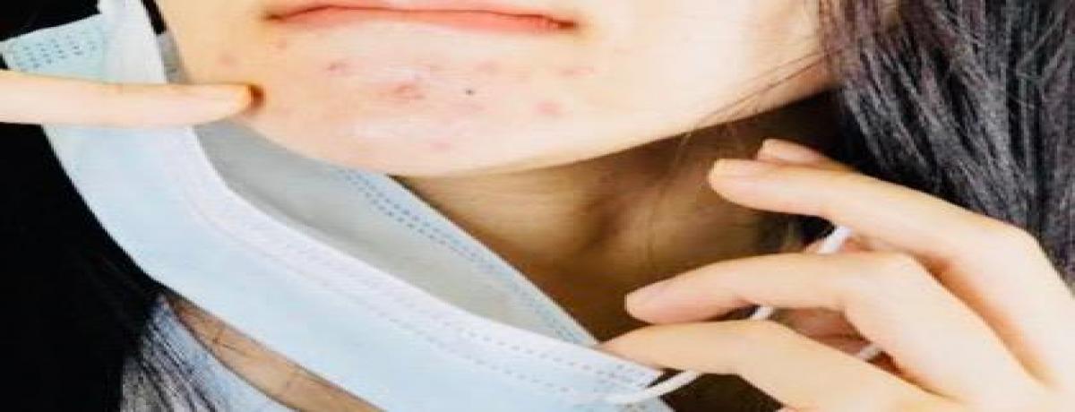 ACNE ACNE